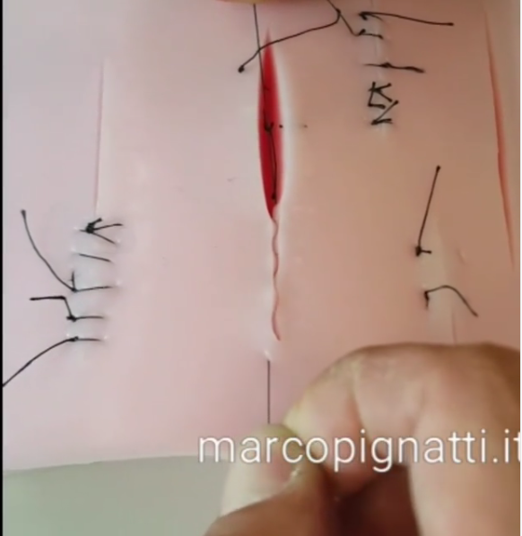 sutura intradermica